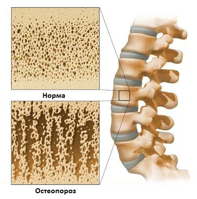 Остеопороз: симптомы, виды, причины, диагностика и лечение